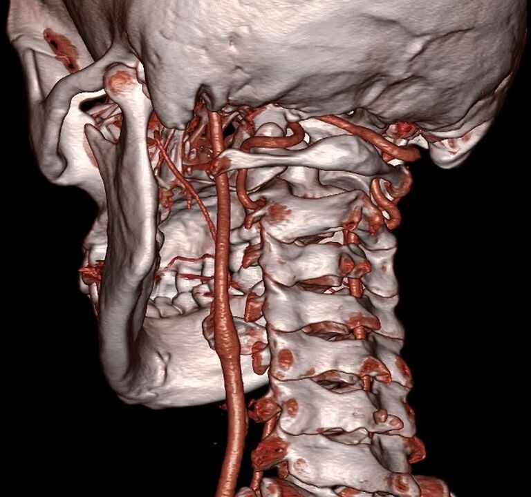 arterie e shtypur me osteokondrozë të qafës së mitrës
