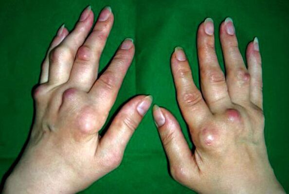 Duart e prekura nga poliosteoartriti deformans