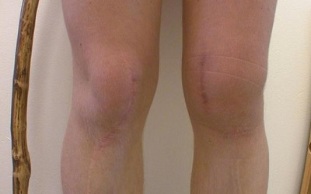 fazat e zhvillimit të artrozës së gjurit