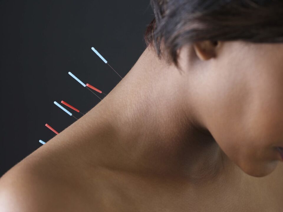 Akupunktura për osteokondrozën e qafës së mitrës eliminon proceset inflamatore