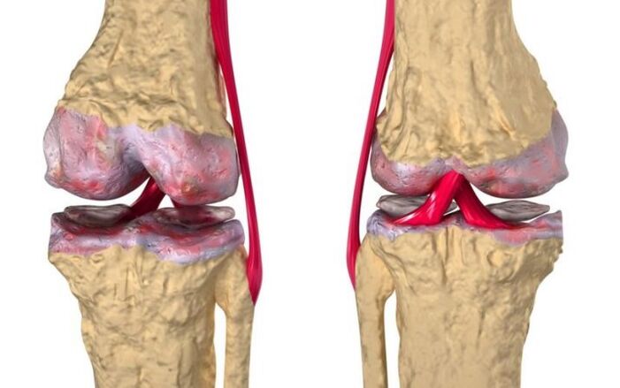 Artroza e kyçit të gjurit