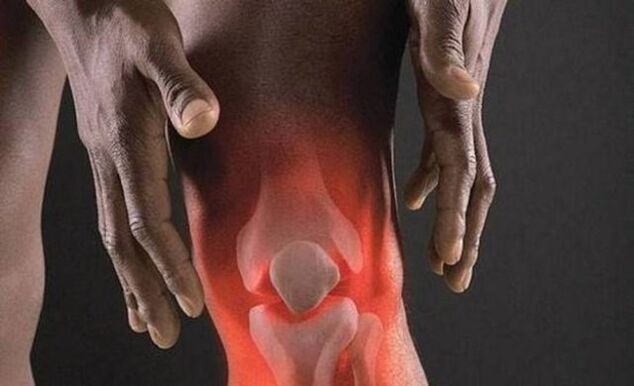 Artroza shoqërohet me një proces inflamator në nyjen e gjurit